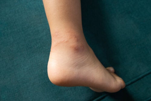 Sea Stings in Children: What to Do in Each Case?