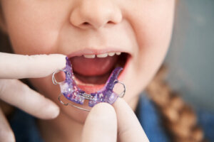 When to Start Orthodontics in Chidren?