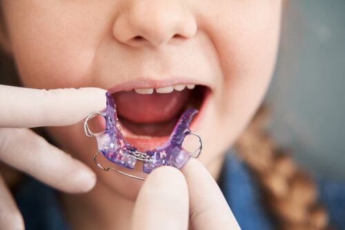 A young girl who needs to start othodontics.