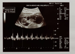 What the Fetal Heartbeat in the Mother's Womb is Like