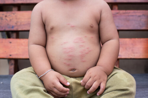 Children with Skin Allergies: Symptoms and Recommendations