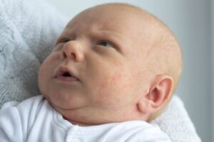 Milia in Babies: What You Should Know