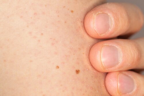 How to Care for the Skin of Children with Keratosis Pilaris?