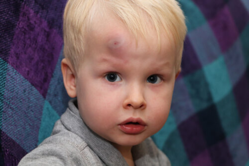 What to Do About Children's Bumps?