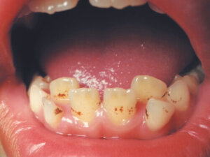 Stains on Children's Teeth Due to Iron Supplementation