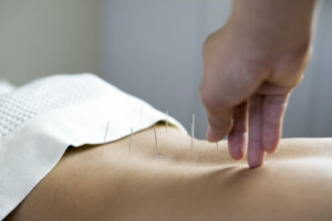 Does Acupuncture to Get Pregnant Work?