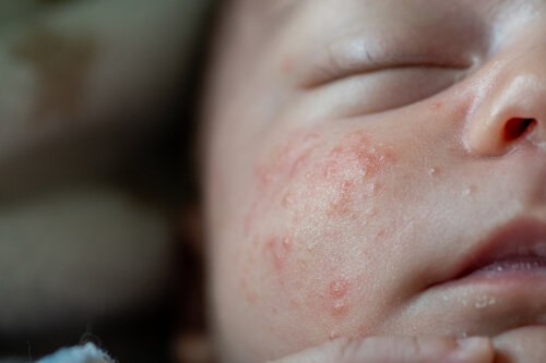 Benign Skin Lesions in Infants: Types and Care