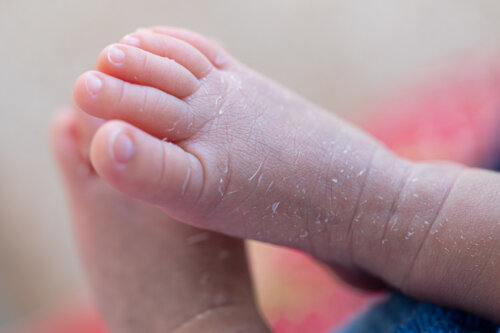 The Causes of Flaky Skin in Babies