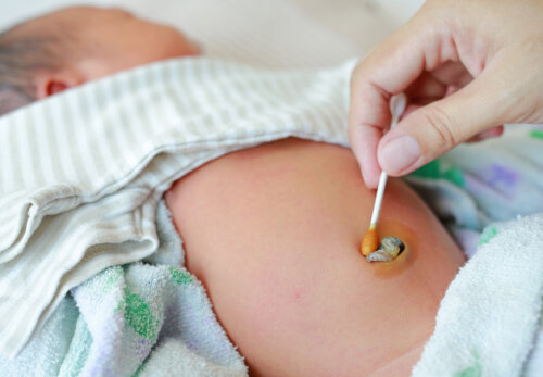 Omphalitis or Navel Infection in Newborns