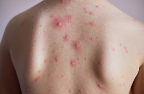 How to Prevent and Treat Chickenpox Scars