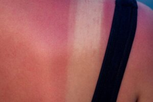 Sunburn During Pregnancy: Risks and Treatment