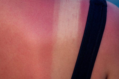 Sunburn During Pregnancy: Risks and Treatment