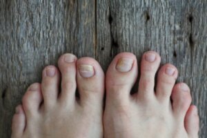 How to Treat Nail Fungus in Children?