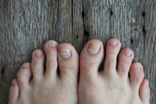 How to Treat Nail Fungus in Children?