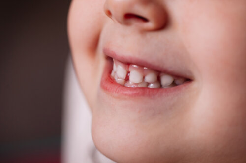 What to Do if Your Child's Baby Teeth Don't Fall Out?