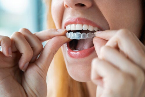 How to Clean Removable Orthodontic Appliances