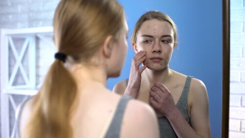 The Effects of Acne on Self-Esteem
