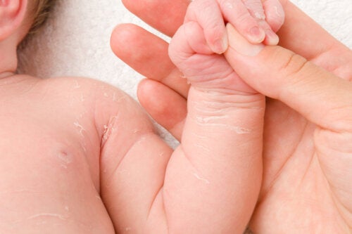 Dry Skin in Infants