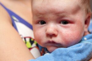 Petechiae in Infants: Symptoms, Causes, and Treatment