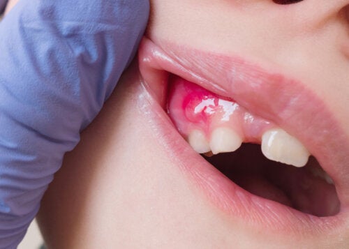 Gum Disease in Children