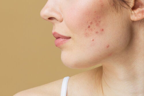Postpartum Acne: Causes and Treatment