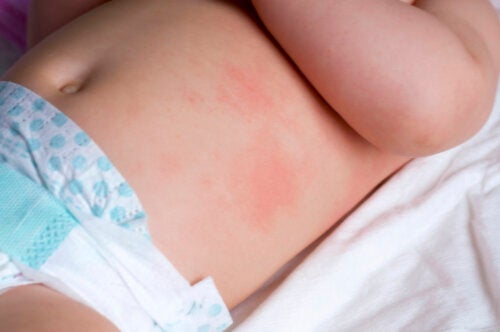 Types of Rashes in Infants and How to Treat Them