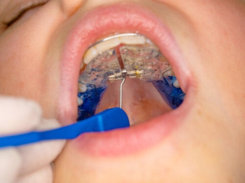 What Is a Palate Expander and When Is It Used?