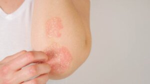 Psoriasis During Pregnancy: What You Should Know