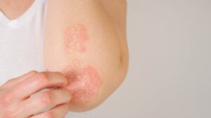 Psoriasis During Pregnancy: What You Should Know