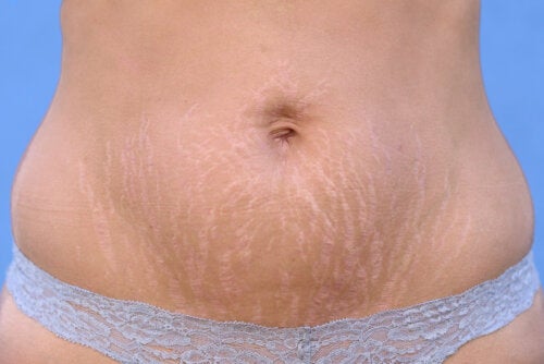 How to Remove Red Stretch Marks?