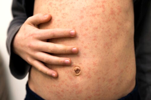 10 Common Causes of Rashes in Children