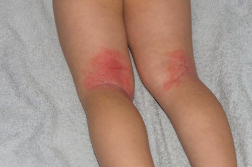 Erythroderma in Children: Symptoms, Causes, and Treatments