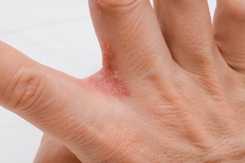 Dyshidrosis in Kids: Symptoms and Causes