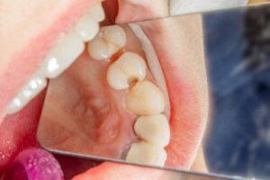 Baby Teeth with Cavities: What's the Best Solution and Why?