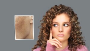 Facial Spots During Pregnancy: How to Treat Them?