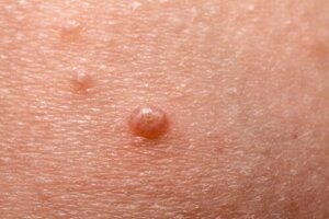 Molluscum Contagiosum in Children: What You Should Know