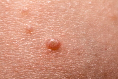 Molluscum Contagiosum in Children: What You Should Know
