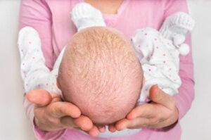 Seborrheic Dermatitis in Infants