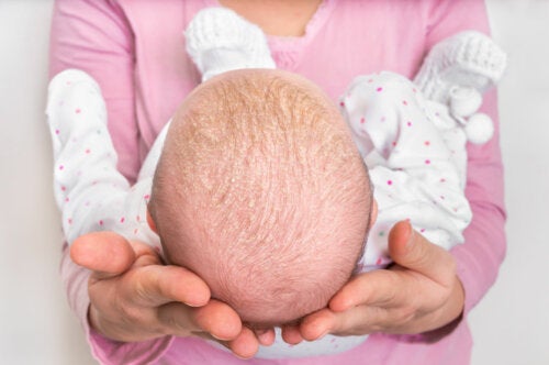 Seborrheic Dermatitis in Infants