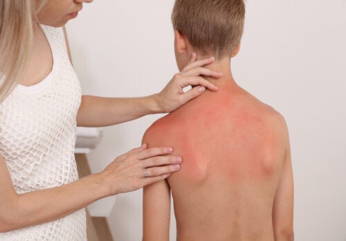 Sunburn in Infants and Children: What You Should Know