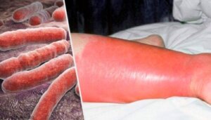 Erysipelas in Children