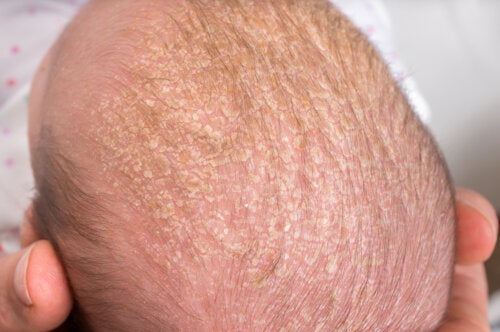 How to Remove Cradle Cap from Babies?