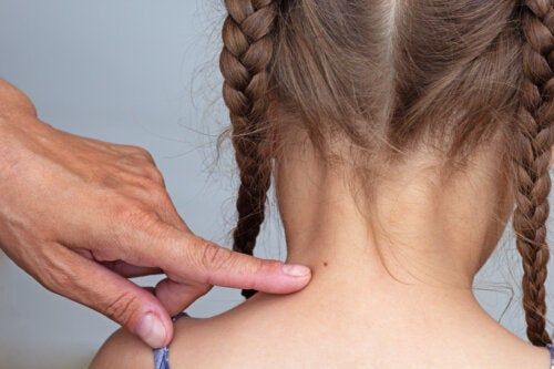 Moles with Hair in Children: What Should You Know?