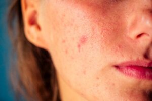 Chickenpox and Shingles During Pregnancy