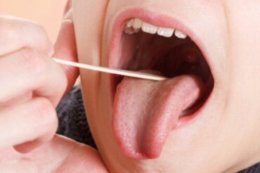 White Palate in Children: What It Means and What to Do
