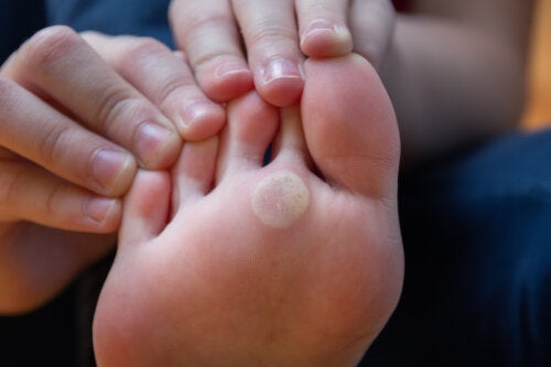 Plantar Warts in Children: What Are They and How to Treat Them?