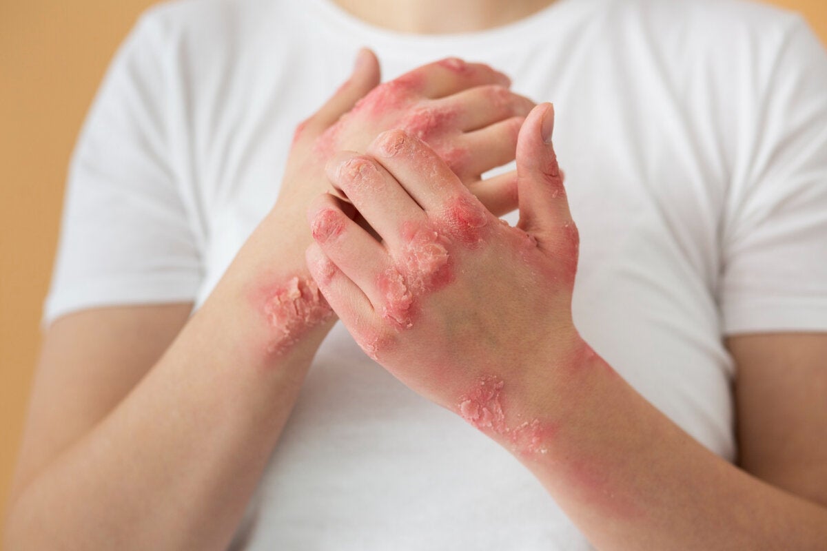 10 Skin Conditions Due to Autoimmune Diseases