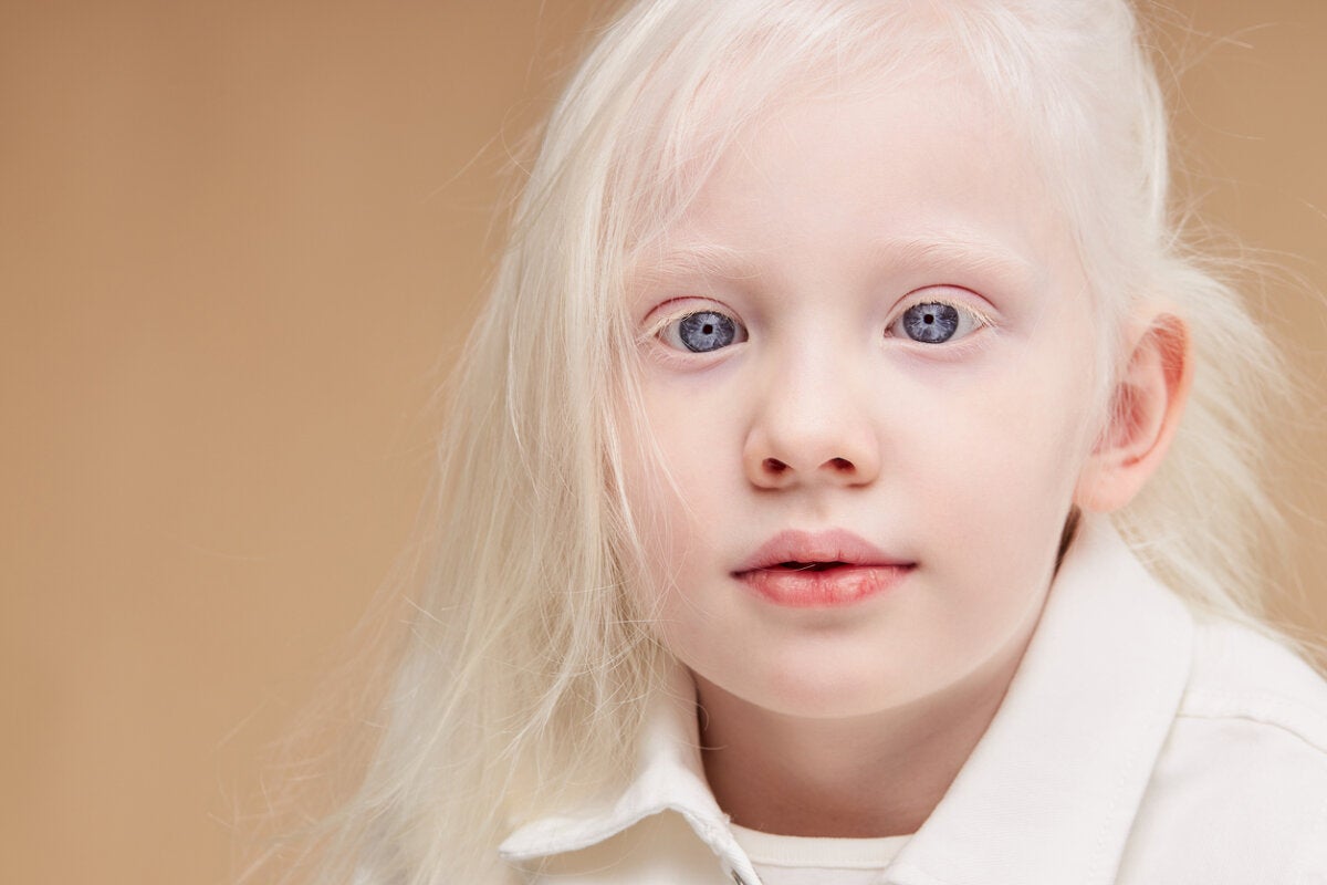 Albinism Rariity How to Care for the Skin of Children with Albinism? 4 Strategies